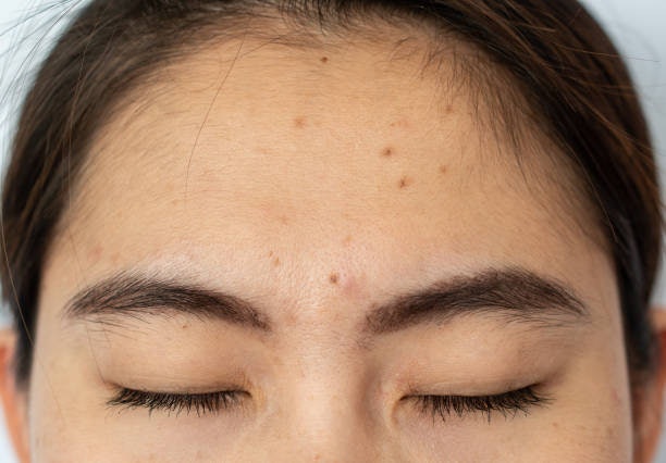 For Acne Scars or Dark Marks: Opt for Brightening and Skin-Renewing Creams