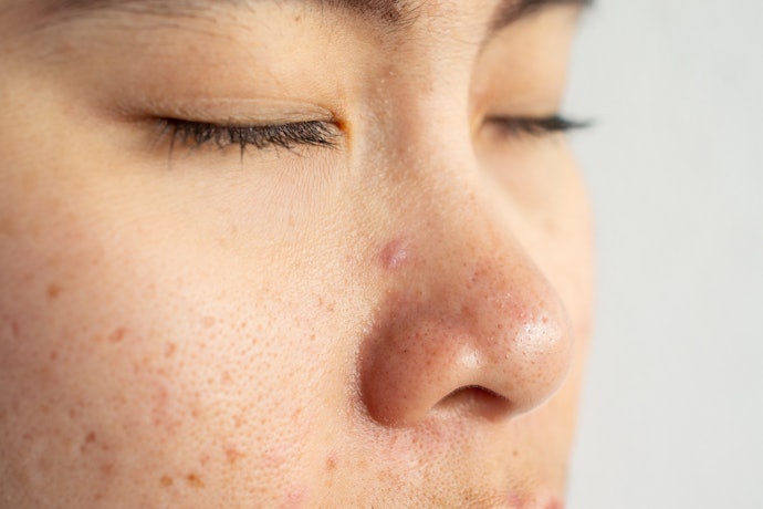 Oily and Acne-Prone Skin: BHA Like Salicylic Acid Deeply Cleanses Pores