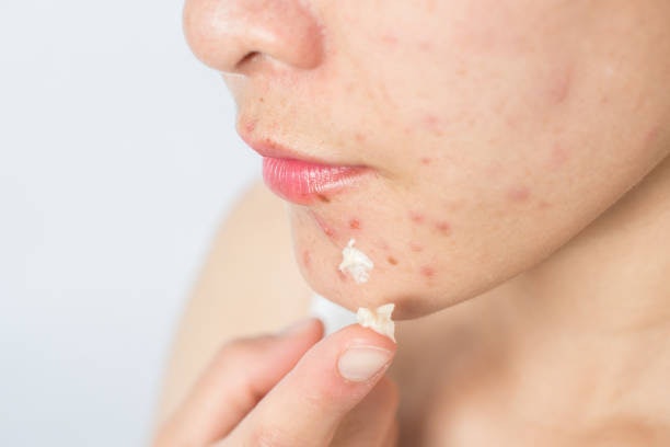 0.25% to 0.5% Is Ideal for Beginners and Those With Dry or Sensitive Skin