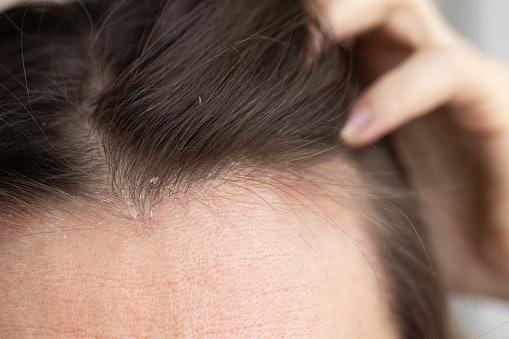 For Dry or Flaky Scalps: Prioritize Formulas With Ceramides, Humectants, or Japanese Plant Oils