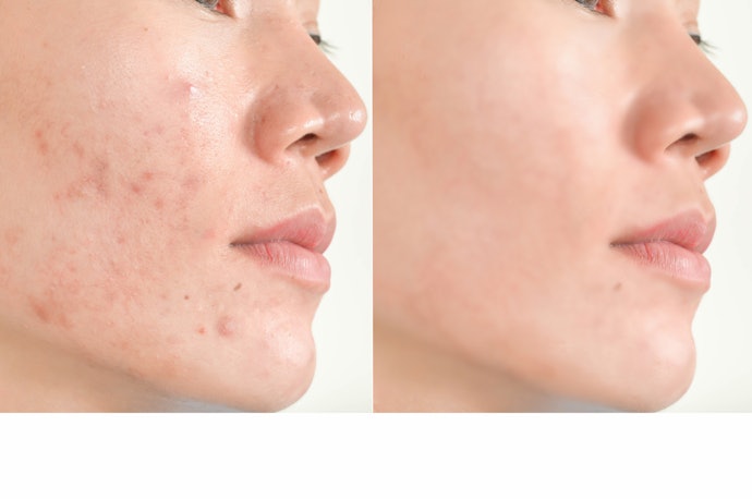 Exfoliate, Renew, and Get Brighter Skin With Glycolic Acid
