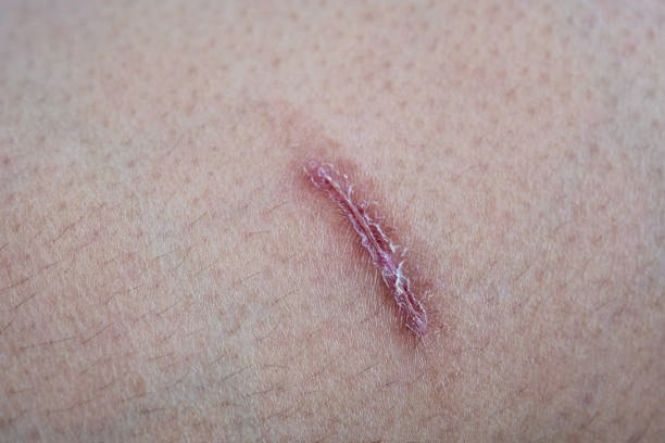 For New or Healing Scars: Choose Silicone-Based Gels or Ointments