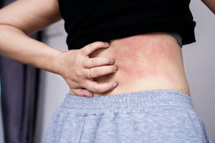 For Skin Allergies Like Hives or Bug Bites: Try Creams or Fast-Acting Oral Antihistamines