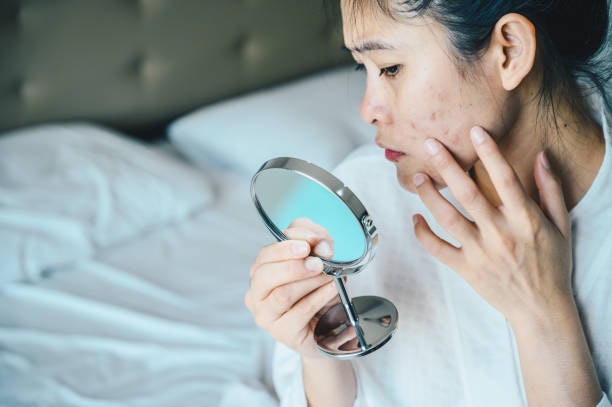 Niacinamide, Arbutin, Kojic Acid, and Licorice Extracts Help Fade Dark Spots