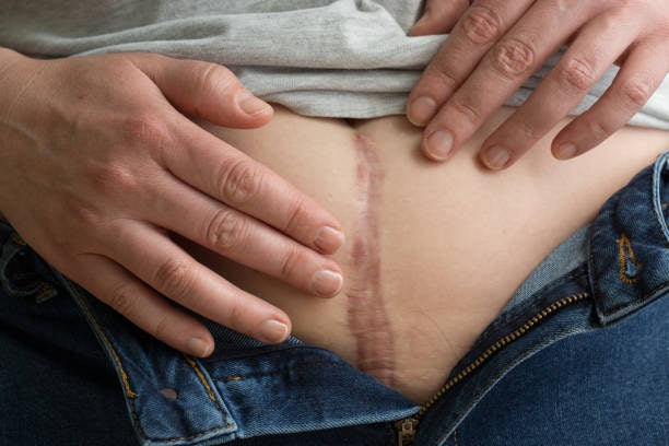 For Flattening Raised Scars: Onion Extract and Silicone Polymers