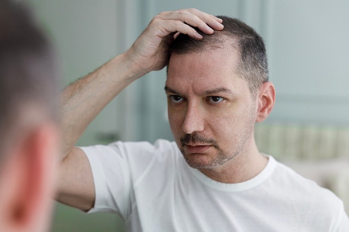 For Hair Loss: Consider Formulas That Help Balance DHT Levels