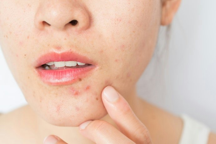 BHA: For Clogged Pores and Blackheads