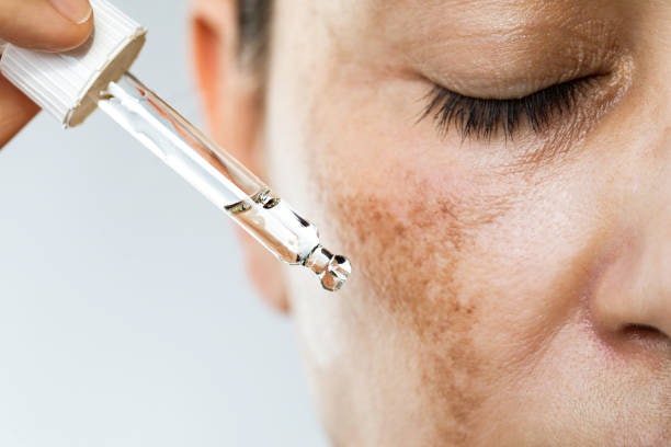 Pick Lightweight Serums for Oily or Acne-Prone Skin
