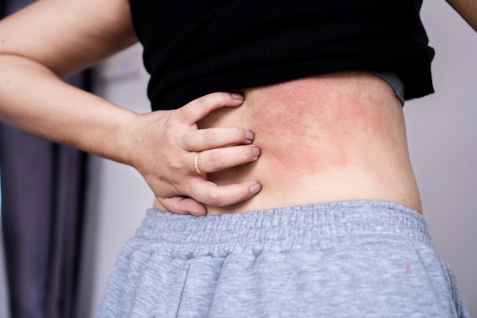 For Skin Allergies Like Hives or Bug Bites: Try Creams or Fast-Acting Oral Antihistamines