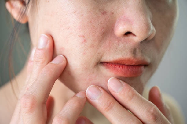 Minimize Pores, Fines Lines, and Acne With Retinoids