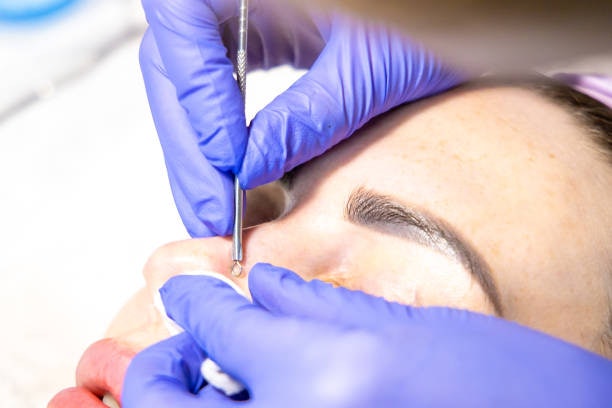 Remove Blackheads With a Comedone Extractor