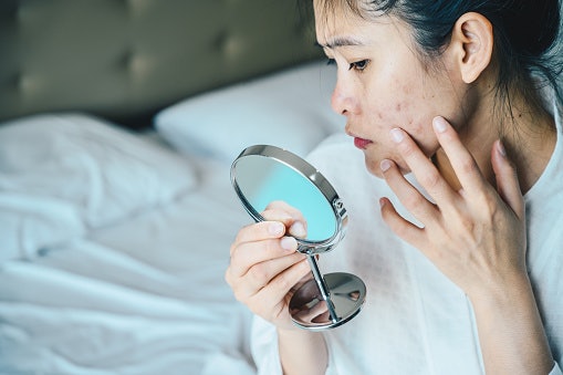 Eliminate Acne-Causing Bacteria With BHA