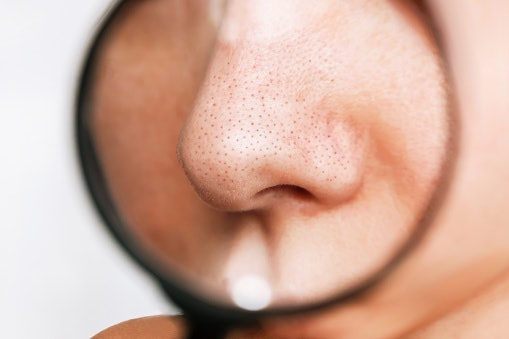 Salicylic Acid Clears Pores and Controls Breakouts