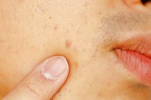 For Brightening and Dark Spot Reduction: Niacinamide, Vitamin C, or Alpha Arbutin