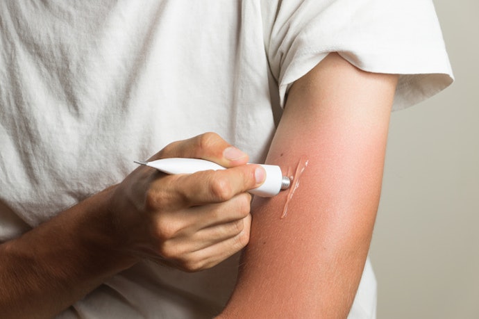 For Small Superficial Second-Degree Burns, Choose Protective Moist-Healing or Antibacterial Ointments
