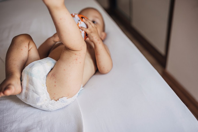 Use Zinc Oxide or Barrier Creams on Irritated or Friction-Prone Areas