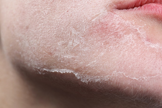 Avoid Irritants and Higher-Risk Ingredients Like Hydroquinone and Tretinoin