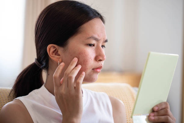 For Sensitive or Irritated Skin: Pick Green Tea Masks With Soothing Properties