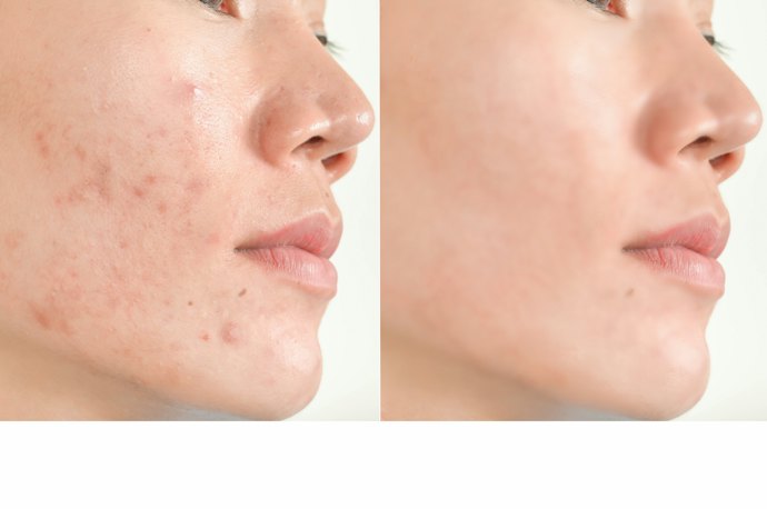 Exfoliate, Renew, and Get Brighter Skin With Glycolic Acid