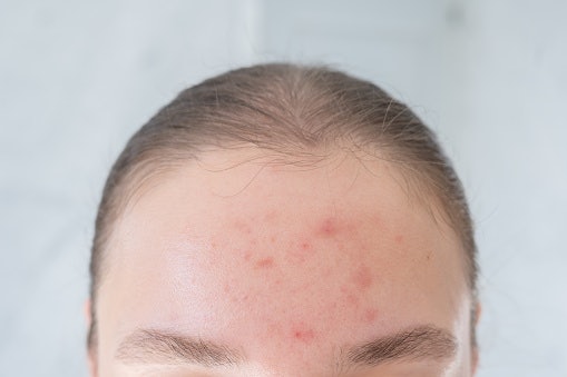 For Acne and Oil Control: Salicylic Acid, Tea Tree, or Benzoyl Peroxide