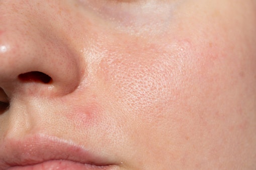 Clay (Kaolin or Bentonite) or Charcoal Absorbs Excess Oil and Draws Out Impurities