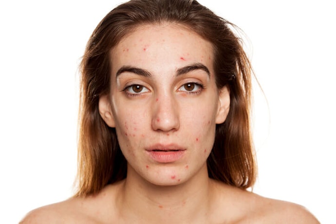For Acne-Prone Skin, Look for Non-Comedogenic BB Creams With Salicylic Acid
