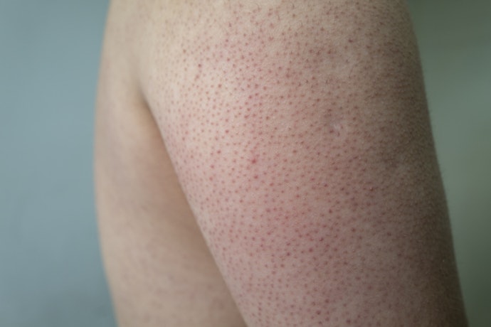 For Keratosis Pilaris: Salicylic Acid and Urea