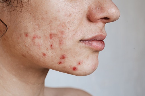 Benzoyl Peroxide or Tea Tree Oil Kills Acne-Causing Bacteria and Dries Out Pimples