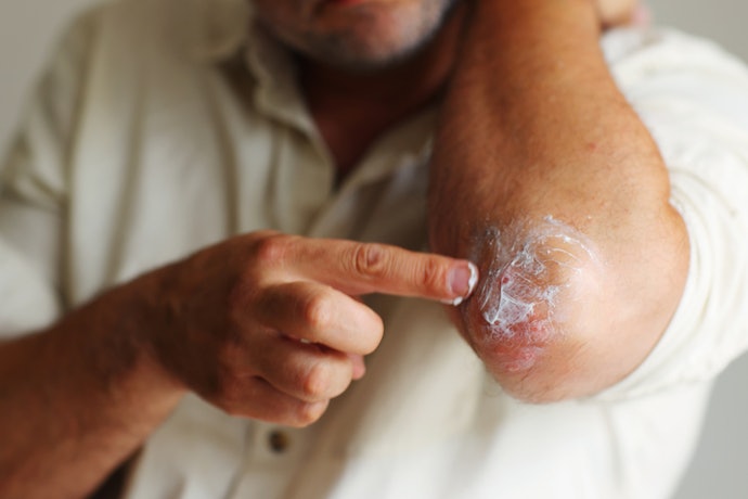 Creams: Best for Daily Relief on Moderate Patches