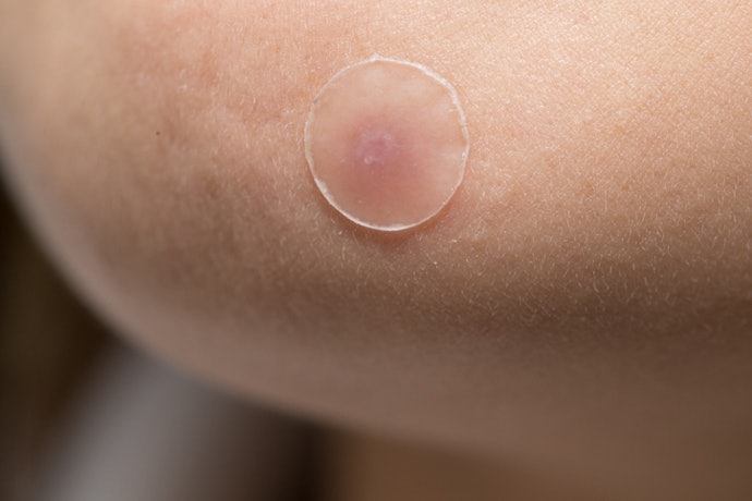Consider an Acne Cream or Pimple Patch to Target Individual Pimples