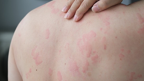 For Hives or Heat Allergies: Aloe Vera or Oatmeal Soaps Relieve Itching