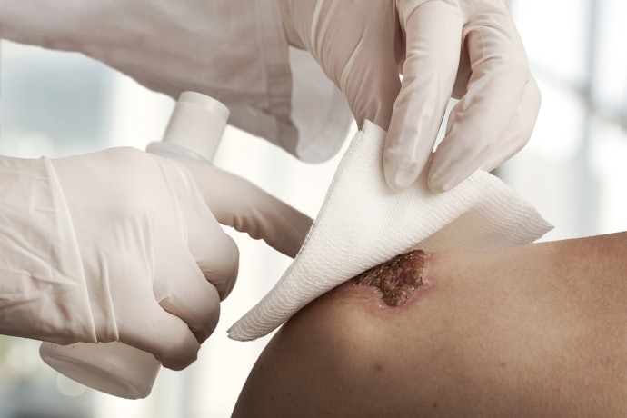 Dressings to Protect Your Wounds