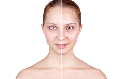 Speed Up Skin Renewal With Adapalene (Retinoid)