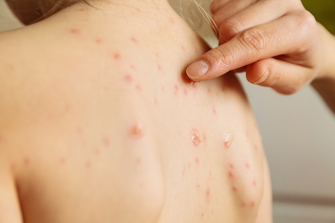 For Inflamed, Red Pimples: Select Benzoyl Peroxide or Sulfur Soap